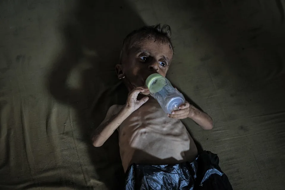Severely malnourished infant in Gaza